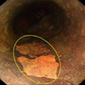 Early esophageal cancer after chromoendoscopy